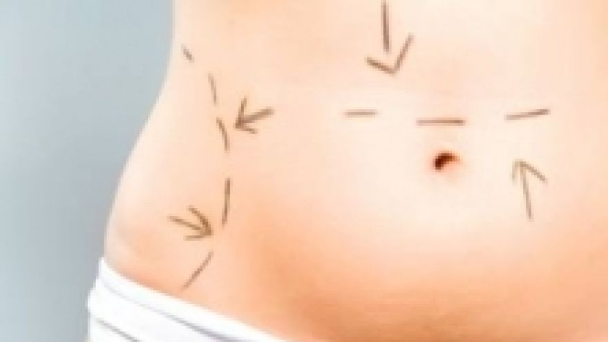 Liposukcja Odsysanie tkanki tłuszczowej
