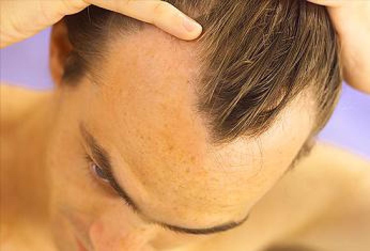 Łysienie androgenne – gdy włos Ci z głowy spada