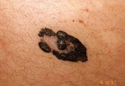 melanoma