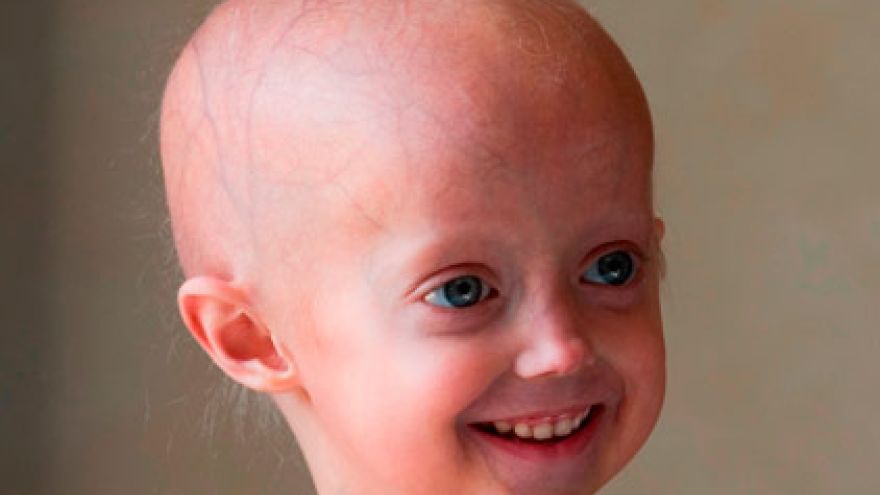 Starość Progeria &#8211; gdy starość przychodzi za wcześnie