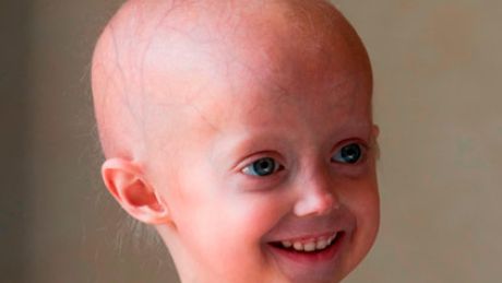 Progeria &#8211; gdy starość przychodzi za wcześnie