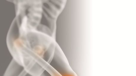 Osteoartroza - co to za choroba?