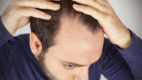 Skąd się bierze łysienie u mężczyzn?