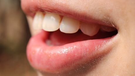 Bruksizm – objawy, przyczyny i skuteczna terapia