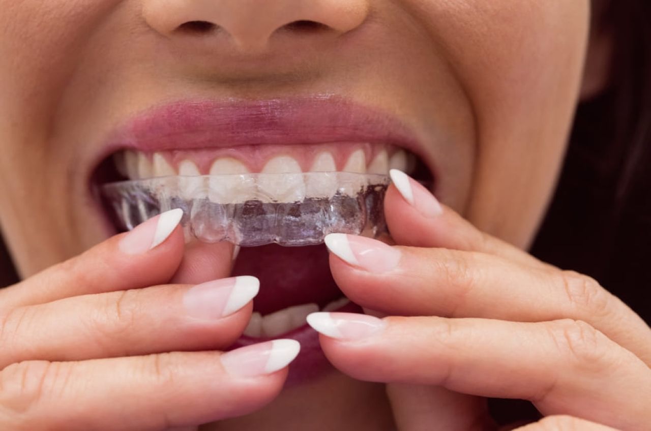 Invisalign – proste zęby, więcej pewności. Ortodoncja dla aktywnych i fit