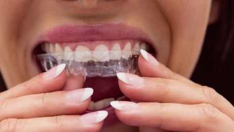 Invisalign – proste zęby, więcej pewności. Ortodoncja dla aktywnych i fit