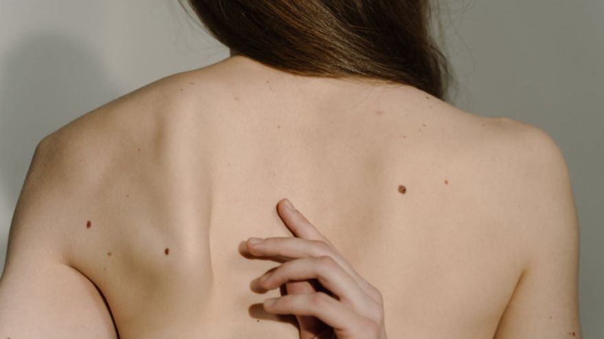 Aktualności Znamiona pod kontrolą – dlaczego warto wykonać dermatoskopię i chronić skórę przed słońcem?