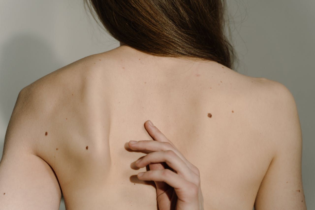Znamiona pod kontrolą – dlaczego warto wykonać dermatoskopię i chronić skórę przed słońcem?