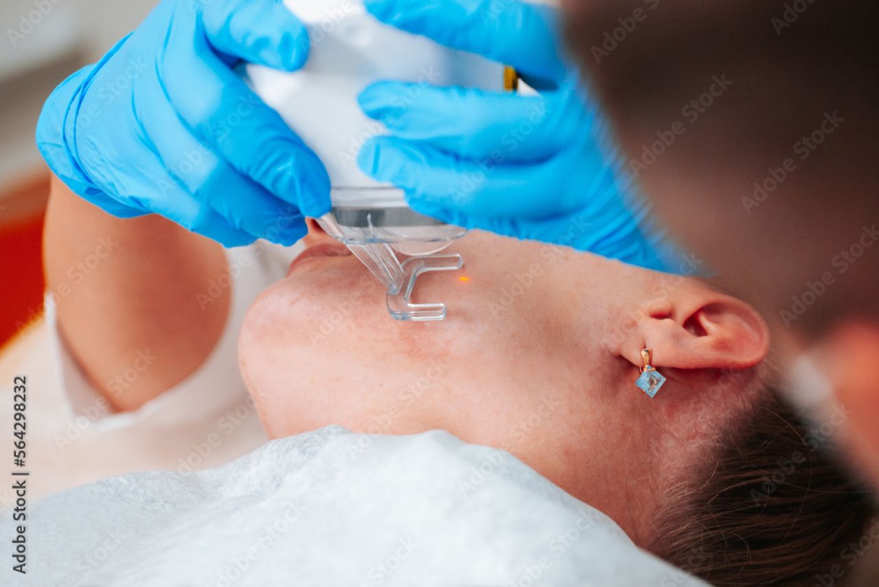 W czym tkwi sekret laserów frakcyjnych